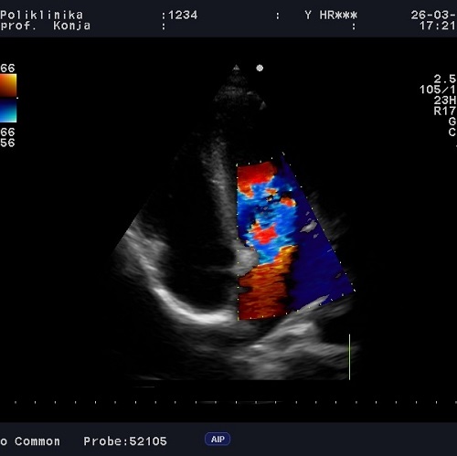 Ultrazvuk srca color doppler