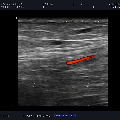 Ultrazvuk zglobova, mišića i tetiva